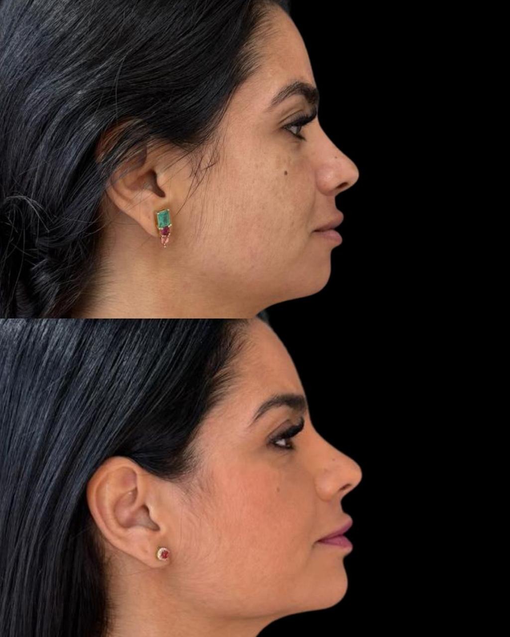 Antes e depois — Harmonização Facial
