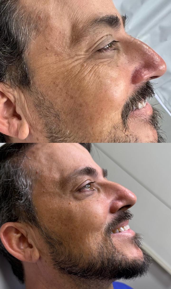 Antes e depois — Botox Masculino
