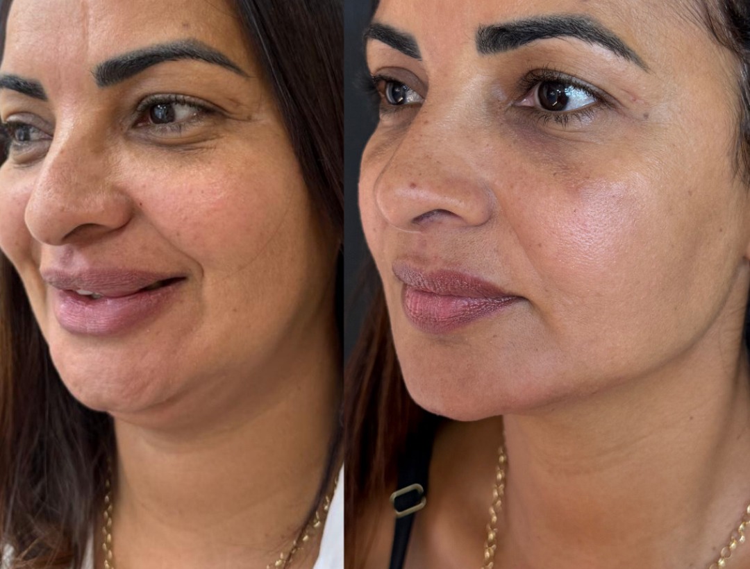 Antes e depois — Harmonização Facial