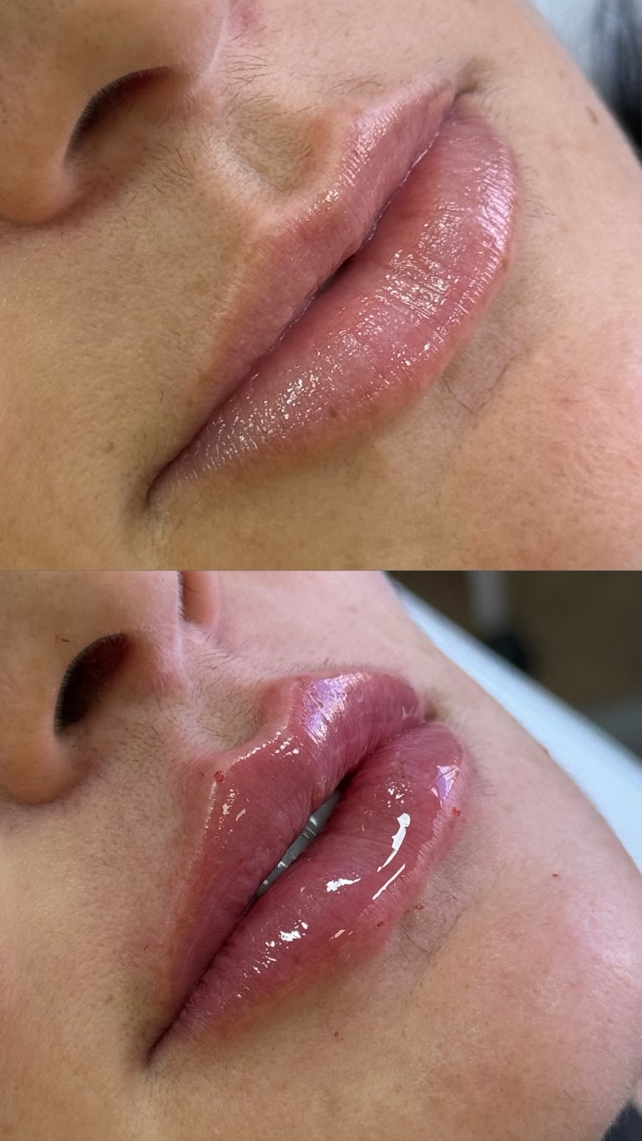 Antes e depois — Preenchimento Labial
